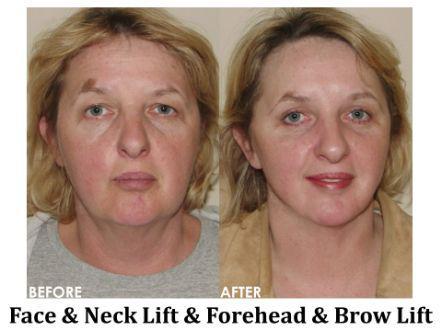 Facelift & Neck Lift Before & After Image