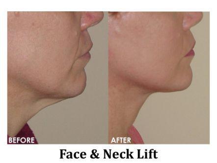 Facelift & Neck Lift Before & After Image