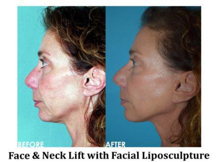 Facelift & Neck Lift Before & After Image