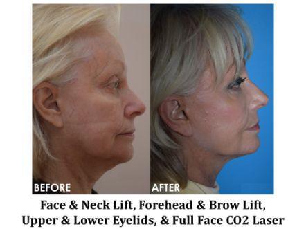 Facelift & Neck Lift Before & After Image