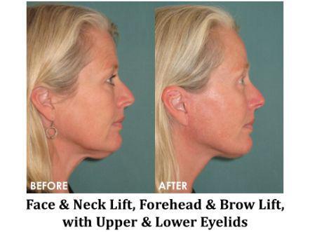 Facelift & Neck Lift Before & After Image