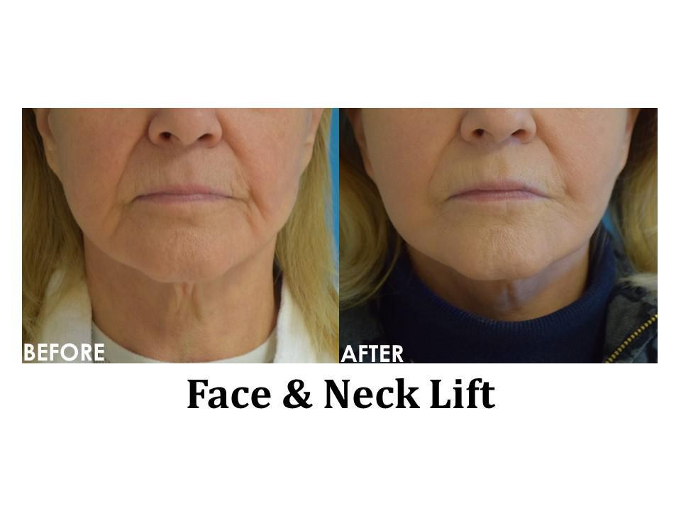Facelift & Neck Lift Before & After Image