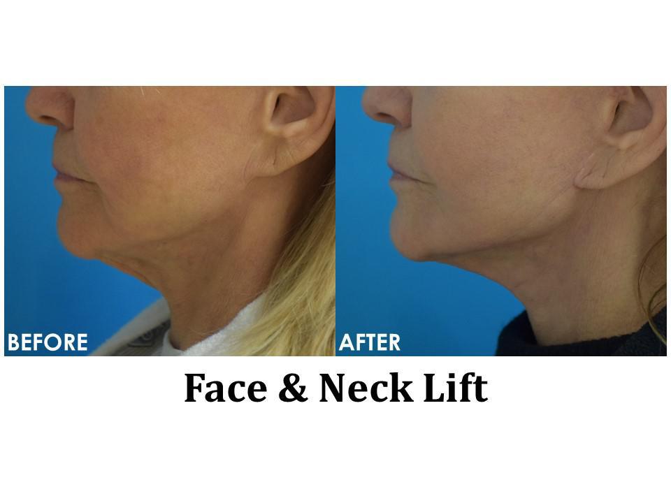 Facelift & Neck Lift Before & After Image