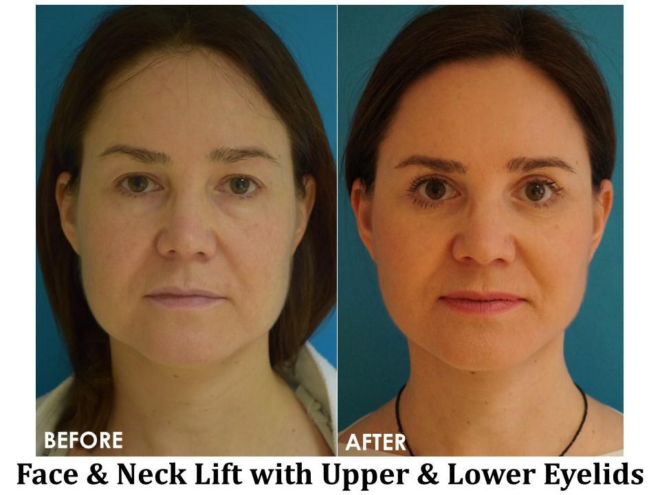 Facelift & Neck Lift Before & After Image