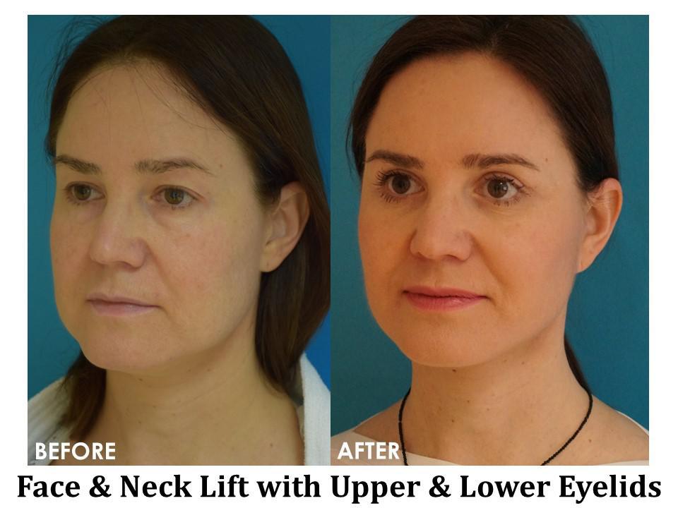 Facelift & Neck Lift Before & After Image
