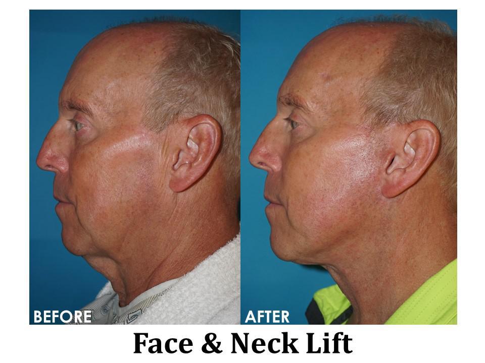 Facelift & Neck Lift Before & After Image