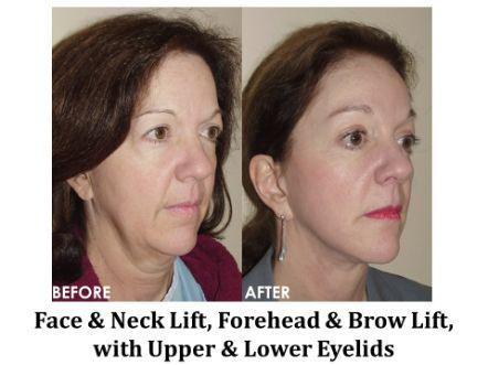 Forehead & Brow Lift Before & After Image