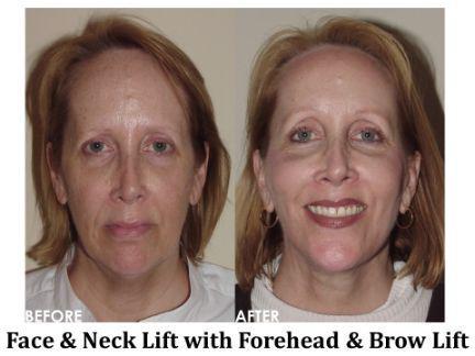 Forehead & Brow Lift Before & After Image