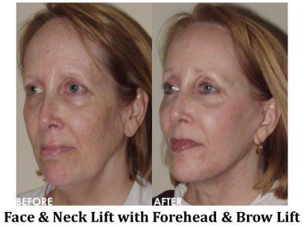 Forehead & Brow Lift Before & After Image