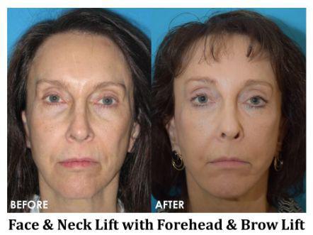 Forehead & Brow Lift Before & After Image