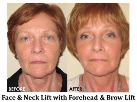 Forehead & Brow Lift Before & After Image