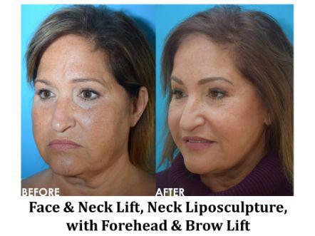Forehead & Brow Lift Before & After Image