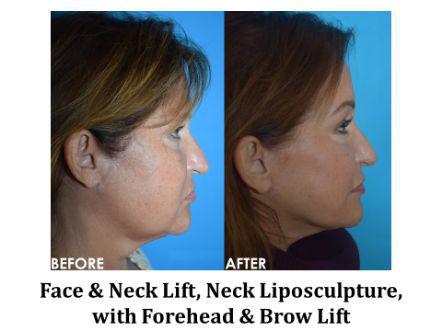 Forehead & Brow Lift Before & After Image