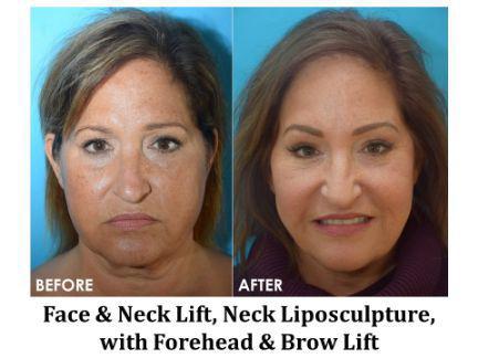 Forehead & Brow Lift Before & After Image