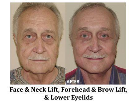 Forehead & Brow Lift Before & After Image