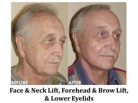Forehead & Brow Lift Before & After Image