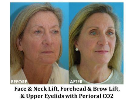 Forehead & Brow Lift Before & After Image