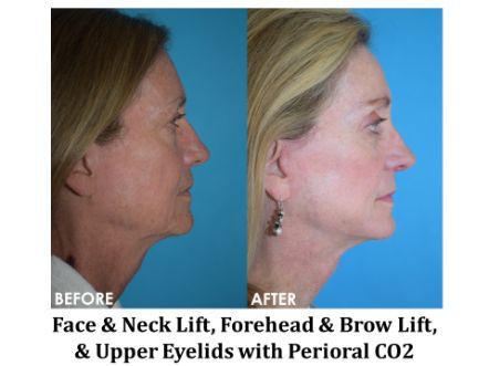 Forehead & Brow Lift Before & After Image