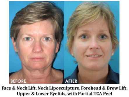 Forehead & Brow Lift Before & After Image