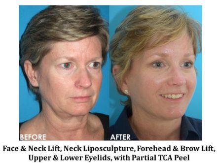 Forehead & Brow Lift Before & After Image