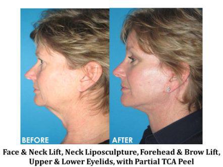 Forehead & Brow Lift Before & After Image