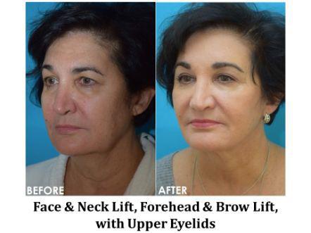 Forehead & Brow Lift Before & After Image