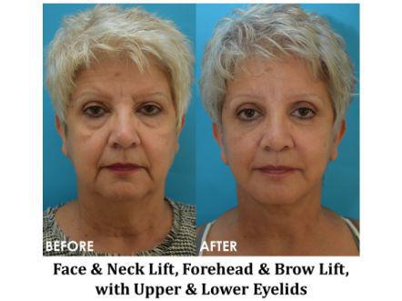 Forehead & Brow Lift Before & After Image