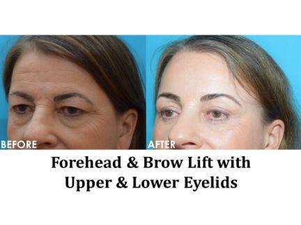 Forehead & Brow Lift Before & After Image