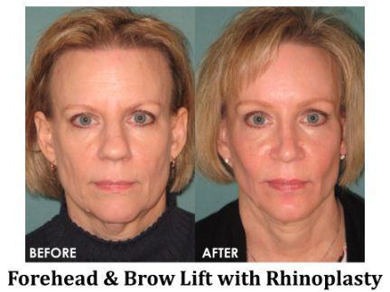 Forehead & Brow Lift Before & After Image