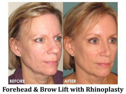 Forehead & Brow Lift Before & After Image
