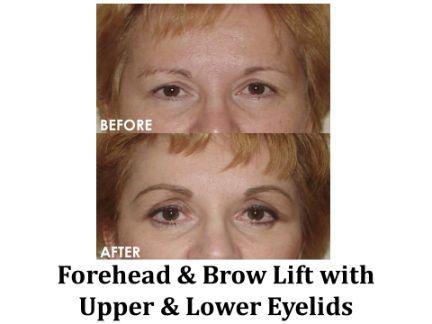 Forehead & Brow Lift Before & After Image