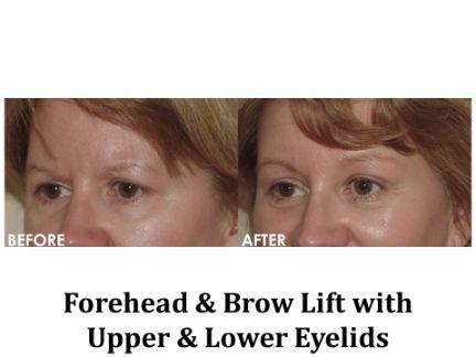 Forehead & Brow Lift Before & After Image