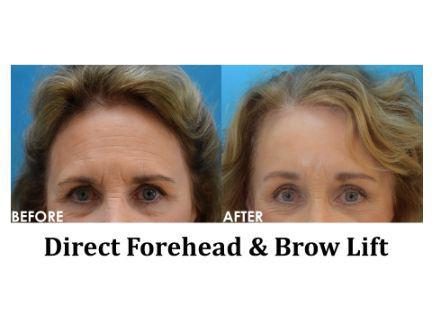 Forehead & Brow Lift Before & After Image