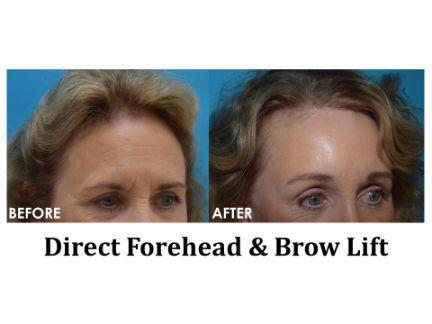 Forehead & Brow Lift Before & After Image
