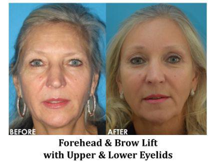 Forehead & Brow Lift Before & After Image