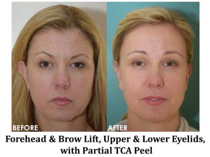 Forehead & Brow Lift Before & After Image