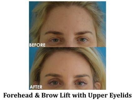 Forehead & Brow Lift Before & After Image
