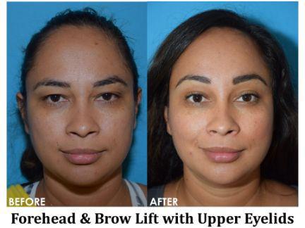 Forehead & Brow Lift Before & After Image
