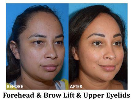 Forehead & Brow Lift Before & After Image
