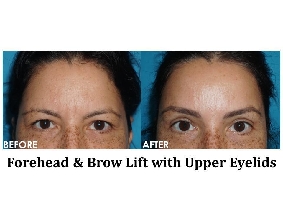 Forehead & Brow Lift Before & After Image