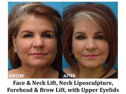Forehead & Brow Lift Before & After Image