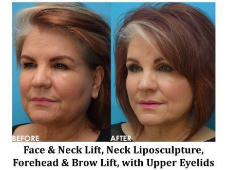Forehead & Brow Lift Before & After Image