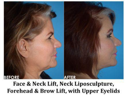 Forehead & Brow Lift Before & After Image