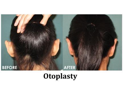 Otoplasty Before & After Image