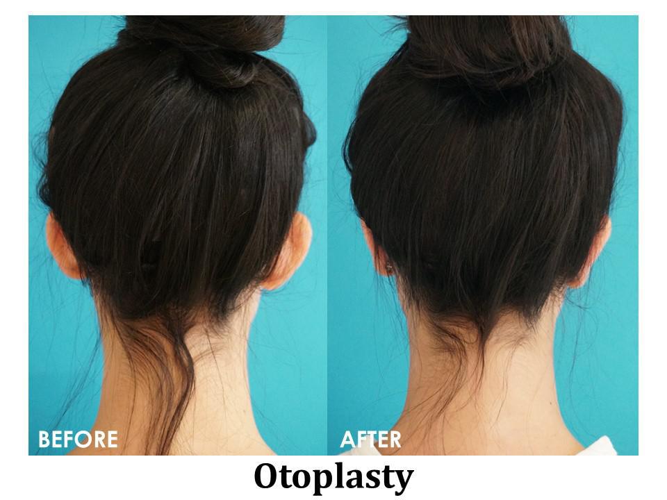 Otoplasty Before & After Image