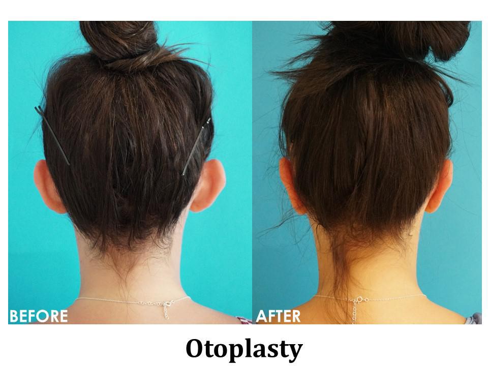 Otoplasty Before & After Image