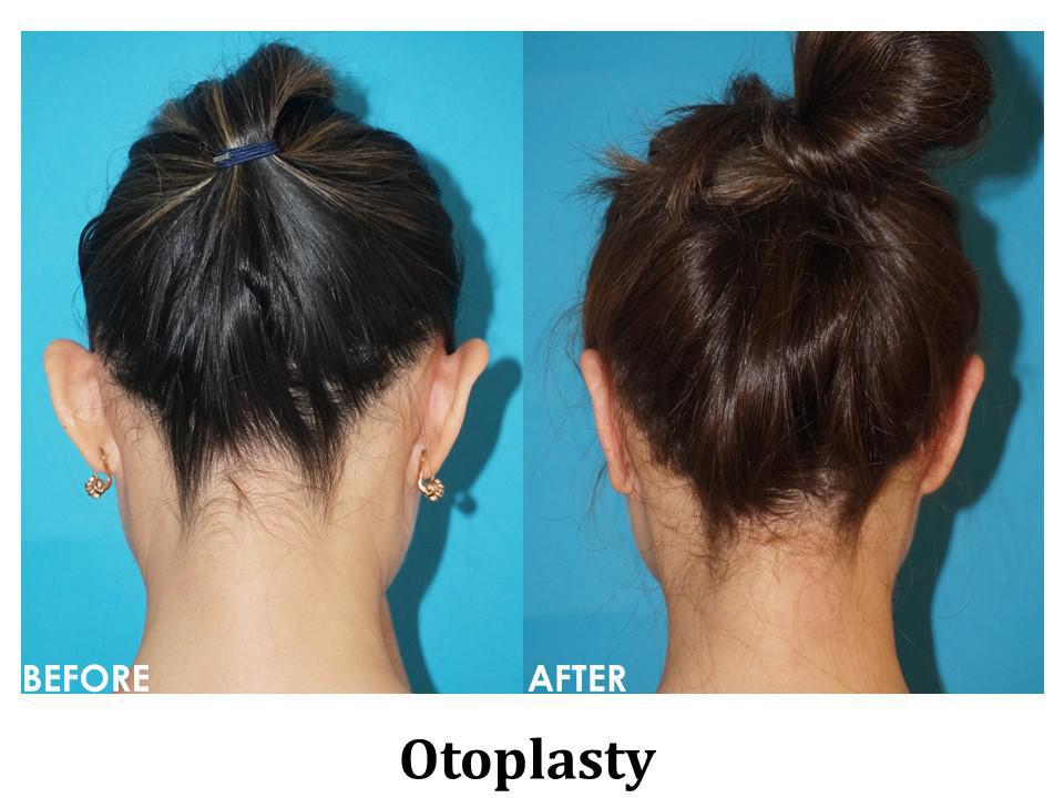 Otoplasty Before & After Image