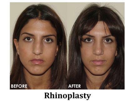 Rhinoplasty Before & After Image