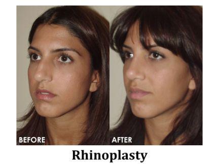 Rhinoplasty Before & After Image
