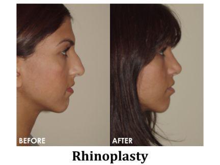 Rhinoplasty Before & After Image